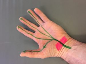 Hand with red shading showing the band of tissue on top of the Carpal Tunnel with the Median nerve in green passing underneath.