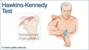 FIGURE 2: The Hawkins-Kennedy test is a popular manoeuvre to determine presence of rotator cuff injury