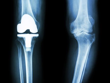 Total Knee Replacement. Tailoring physiotherapy treatment to get the best outcome after surgery