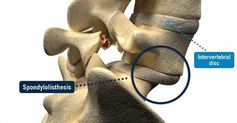 Back Pain: Spondylolisthesis And Andre Agassi