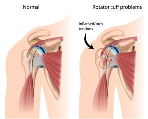 rotator cuff problems due to to inflamed/torn tendons
